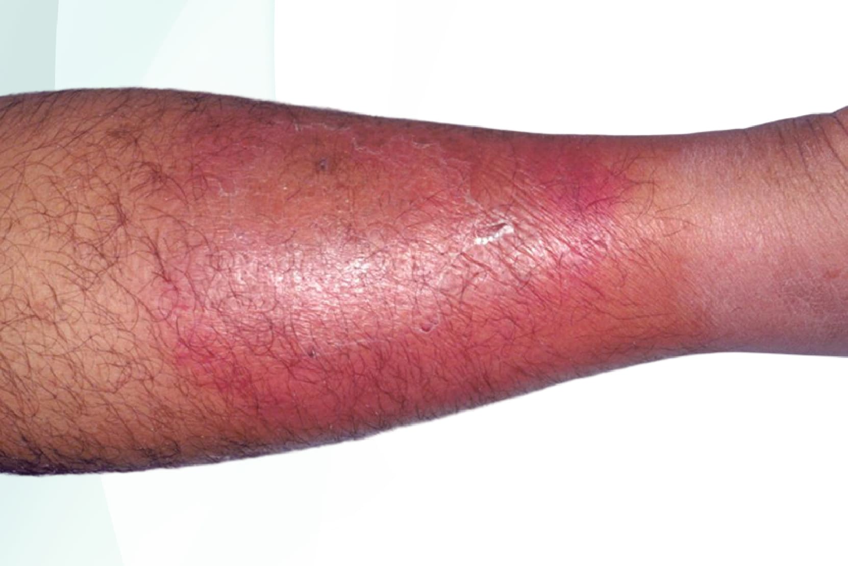 Cellulitis