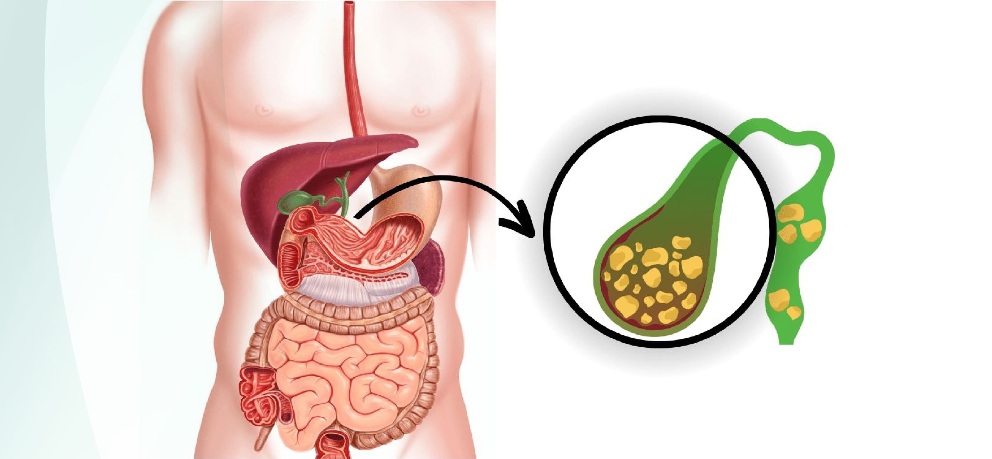 Gallstones