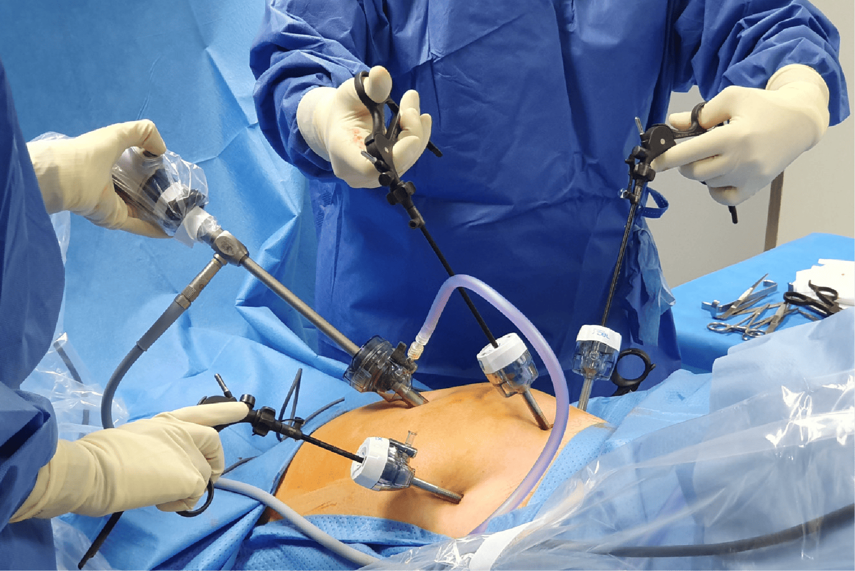 Gallstones