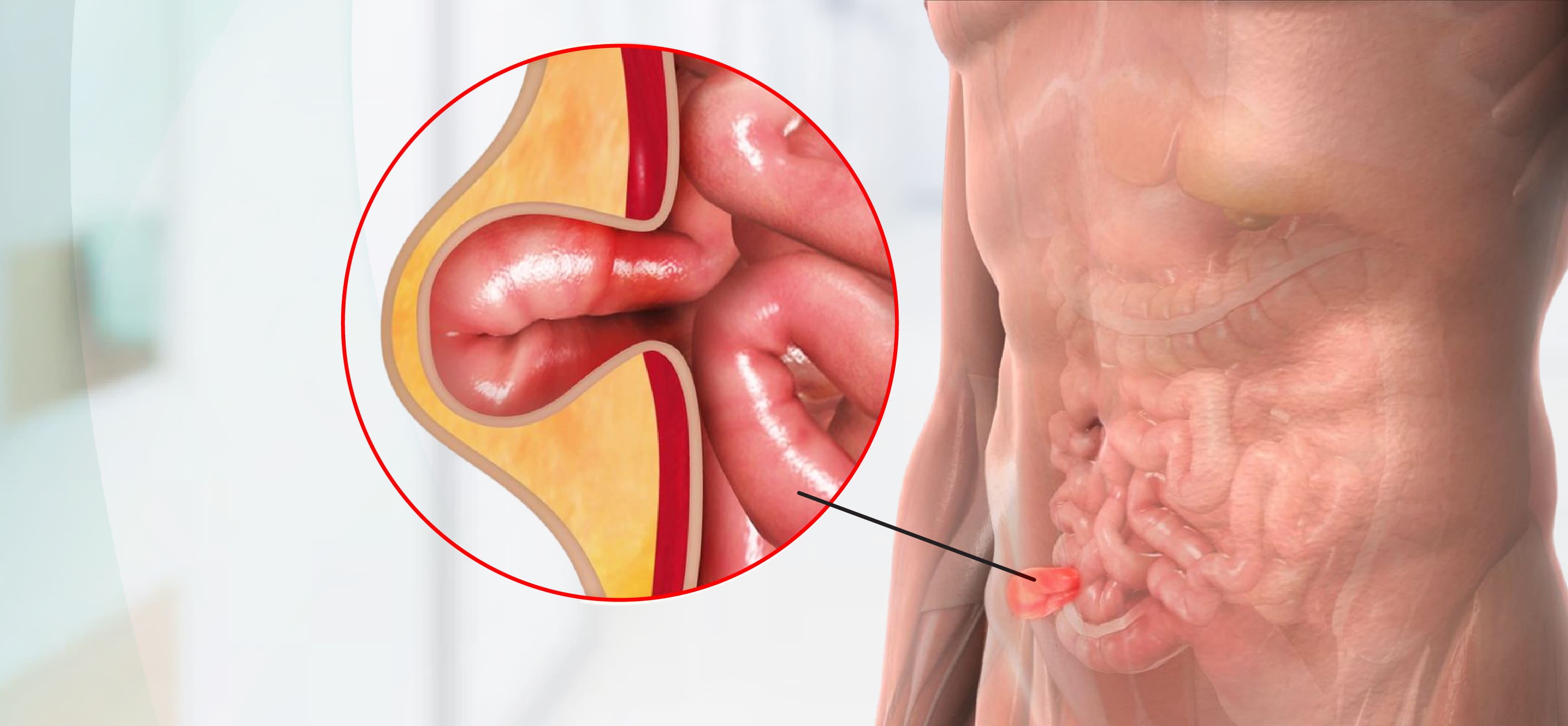 Hernia