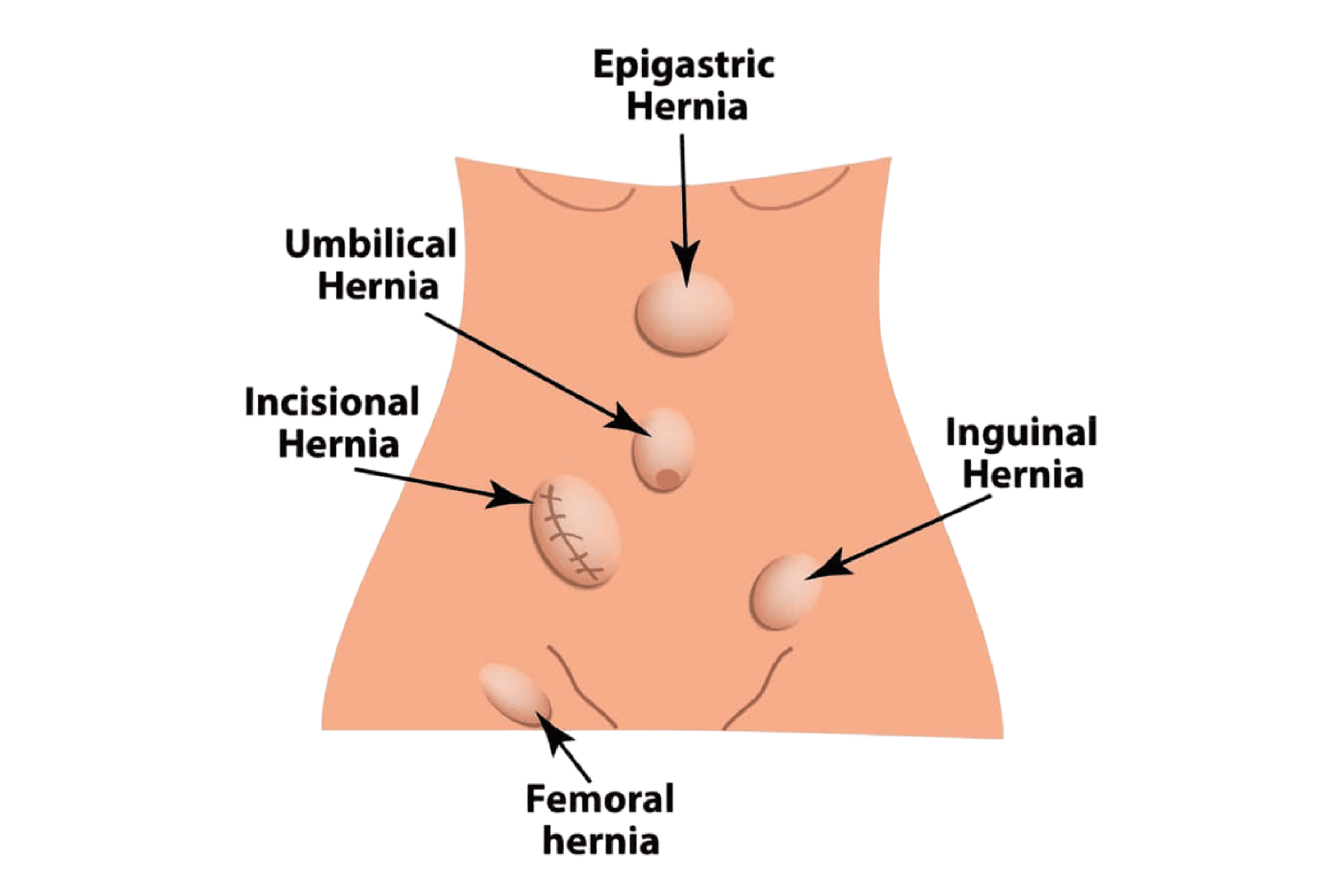 Hernia