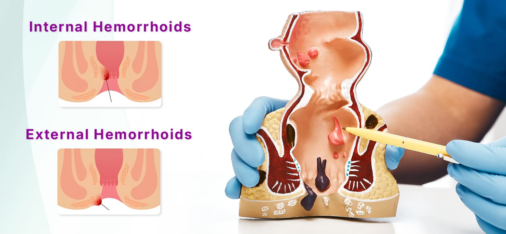 Piles/Haemorrhoids